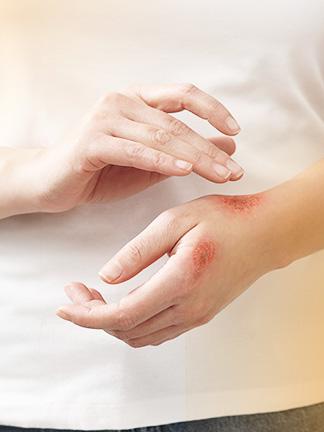 General knowledge about burn wounds and treatment
