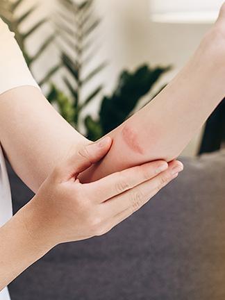 home remedies for treating burns
