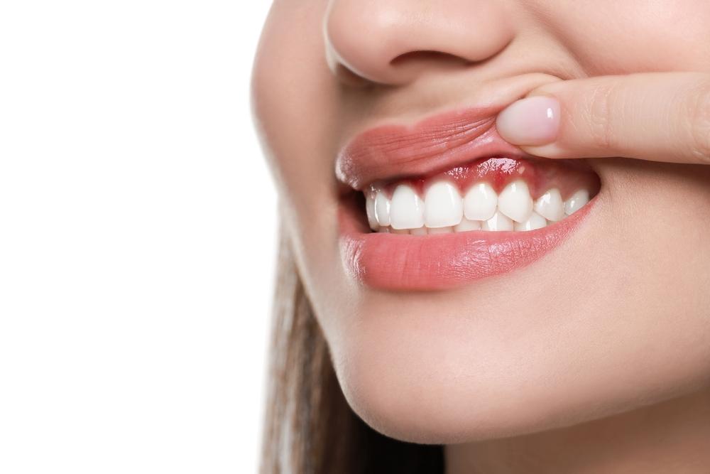 shutterstock_2396982725 ผู้หญิงเป็นโรคเหงือกอักเสบ โดยมีอาการเหงือกบวม แดง