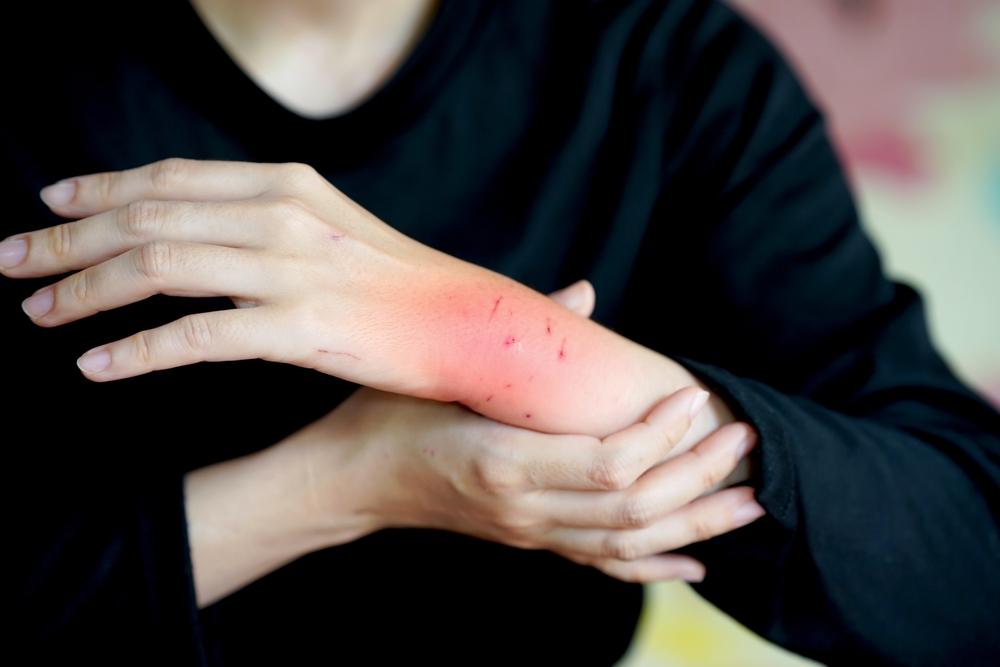 แผลติดเชื้อดูยังไงแผลที่ข้อมือเริ่มอักเสบ มีอาการบวมแดง